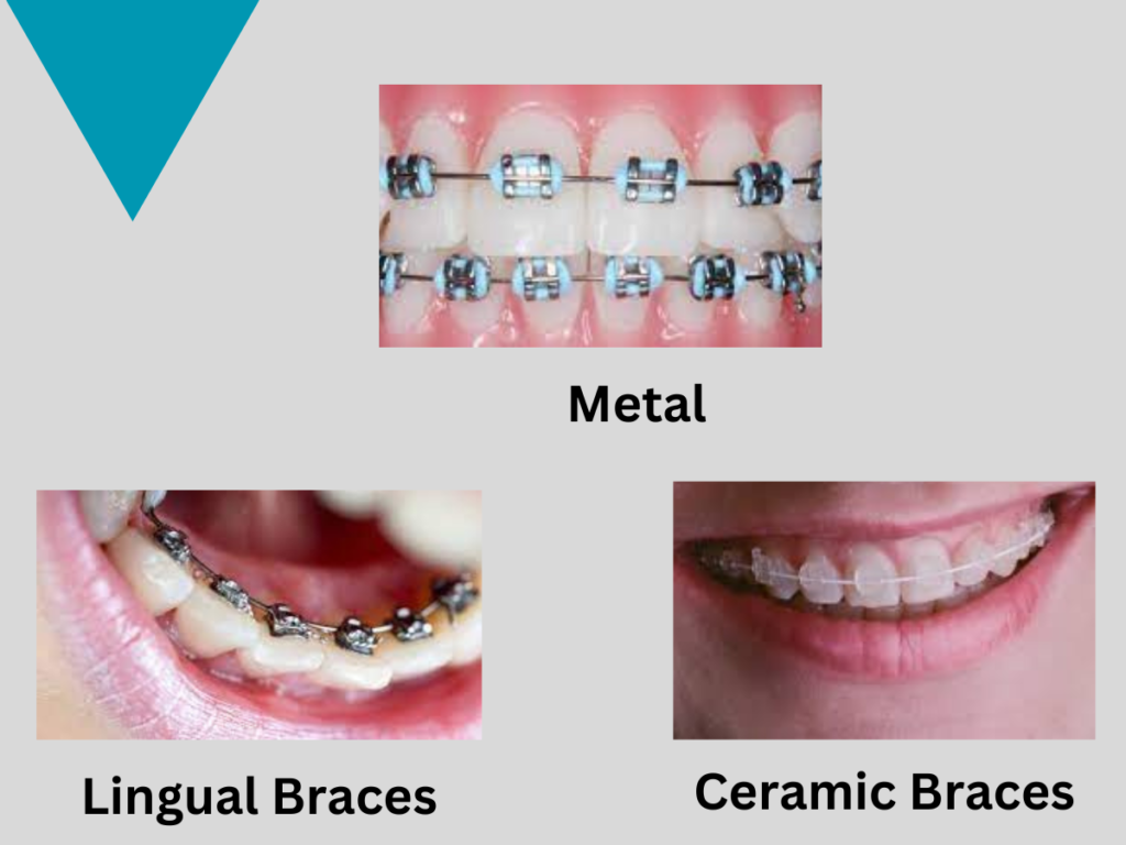 Dental Braces Cost in India A Comprehensive Guide for Affordable