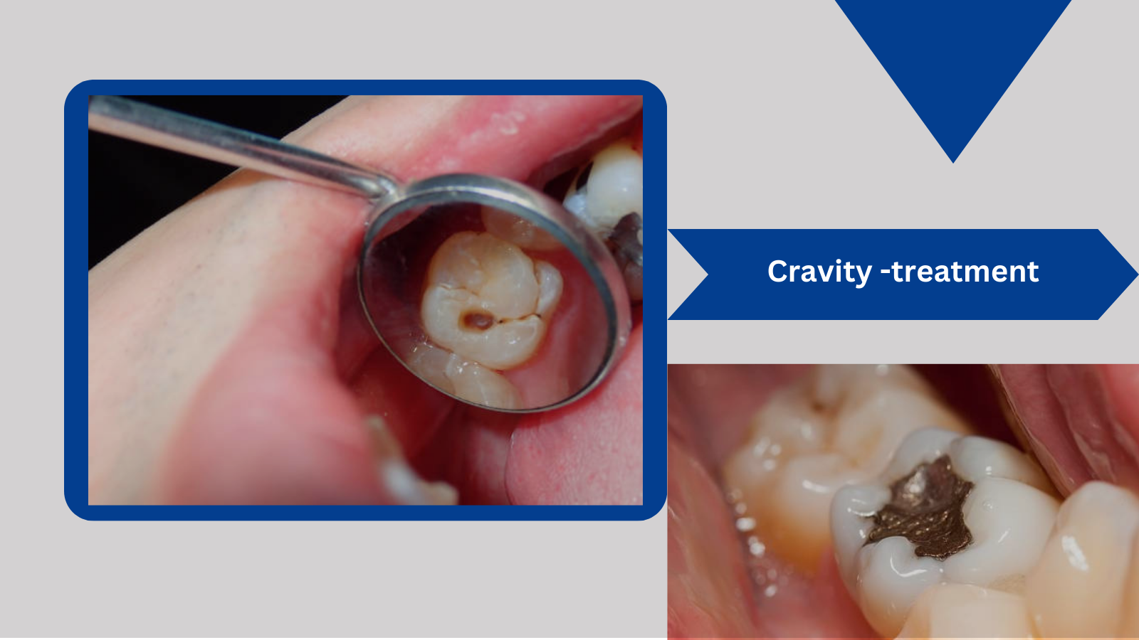 Read more about the article Best Dental Fillings in Kolkata 2023 : Cavity Treatment at Dr Tandon’s Dental Clinic