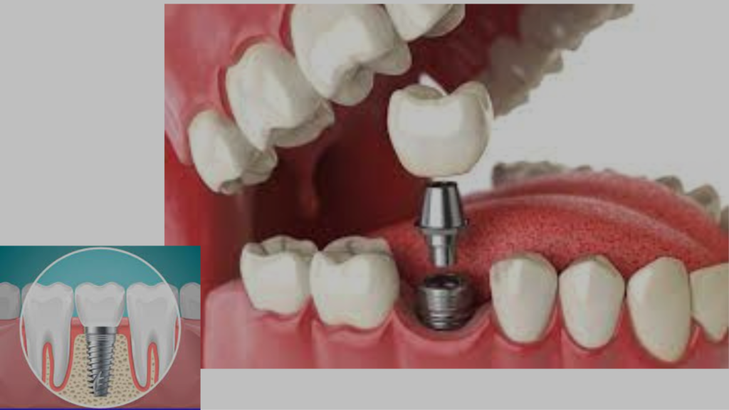 Dental Implant clinic in Kolkata