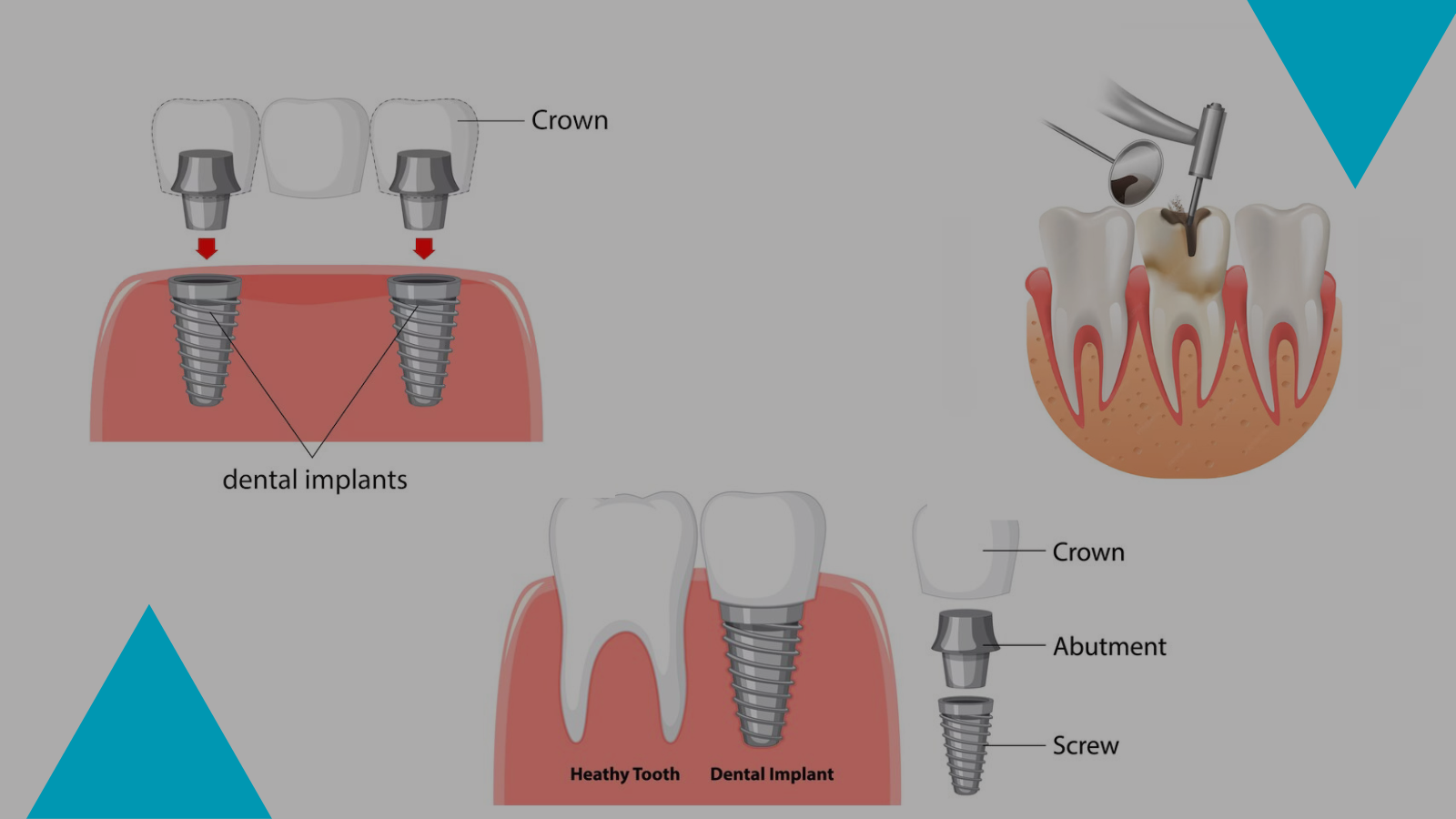 You are currently viewing Discover the Best Dental Implants Clinic in Kolkata for Quality Care 2023