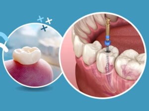 Reasons for Root Canal Treatment