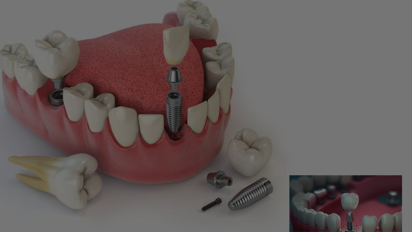 Read more about the article Difference Between Temporary And Permanent Dental Implants in 2023-24