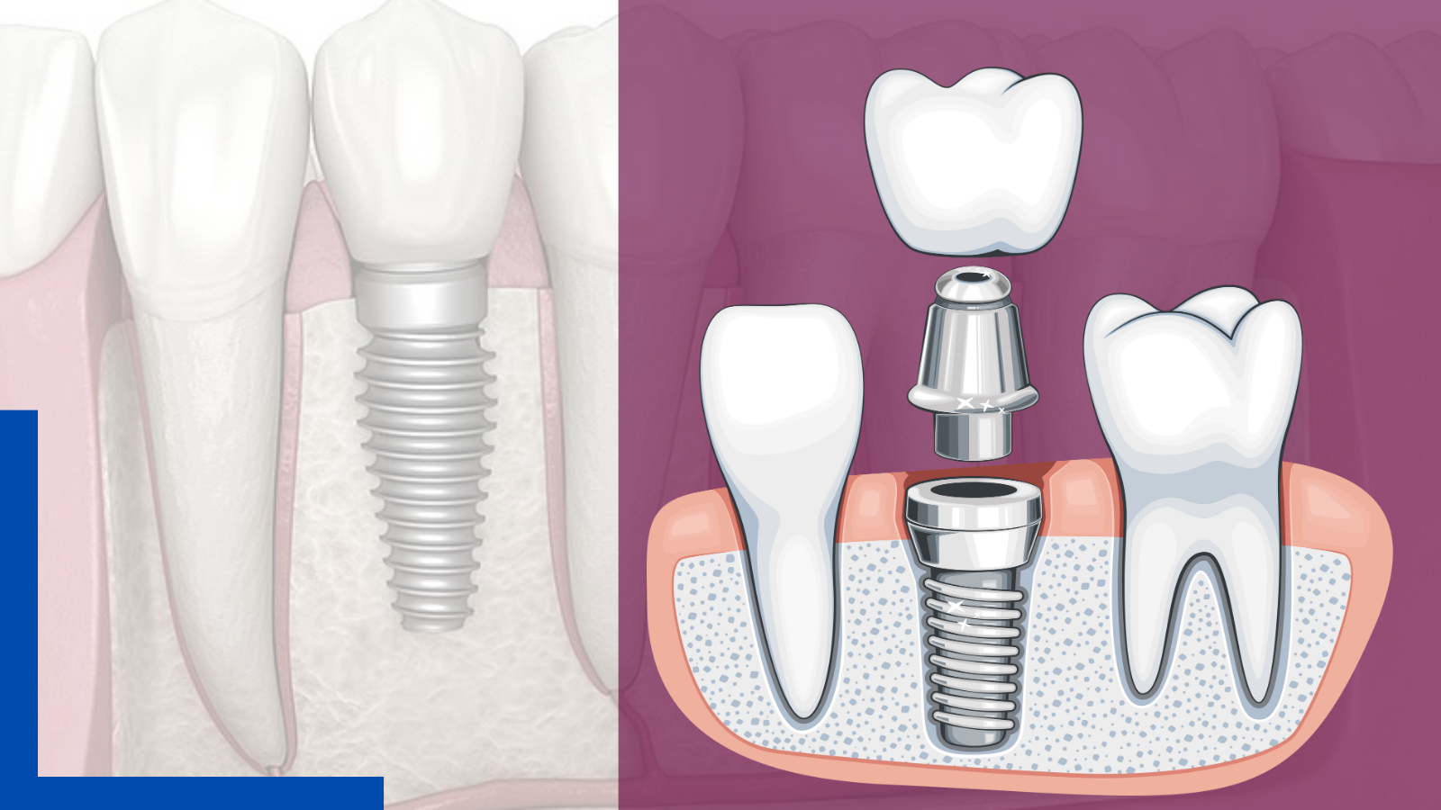 Best Dental Implant Treatment in Kolkata