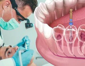 Root Canal Treatment in VIP Road, Kolkata