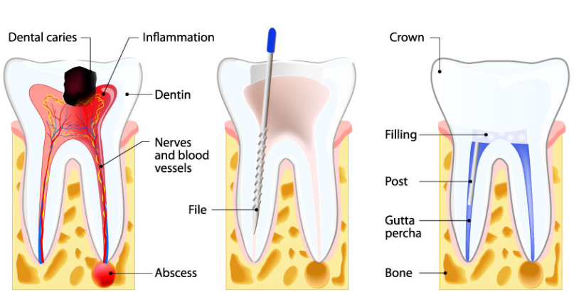 Root canal