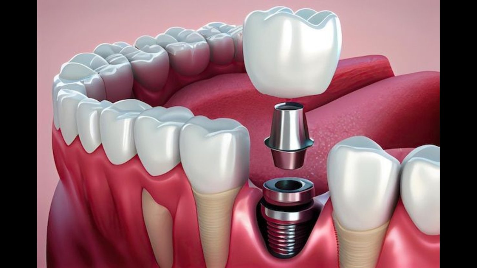 Dental Implants Clinic in Vip Road, Kolkata