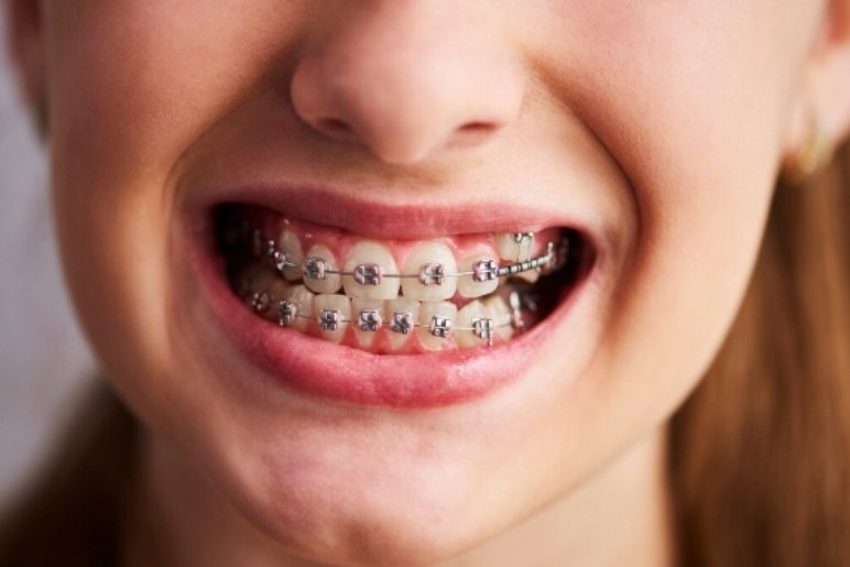 Understanding Metal Braces
