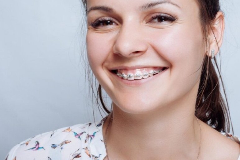 How Ceramic Braces Work